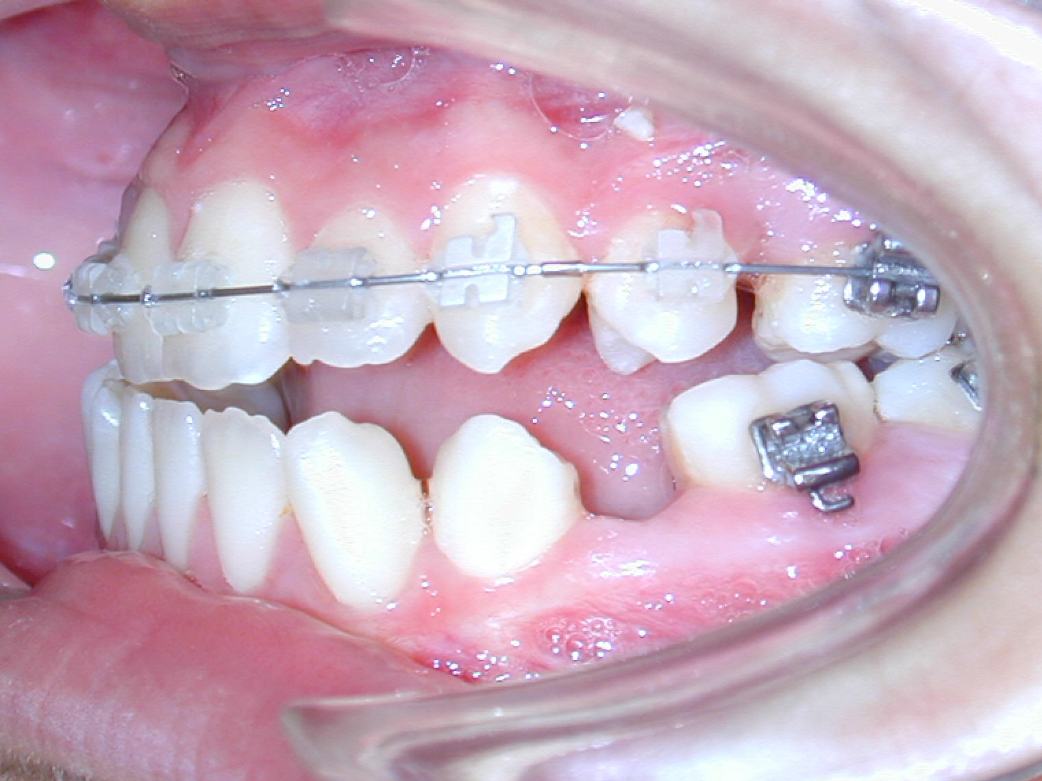 Extraction of molars and premolars by open-bite - Dr. Ignacio García Espona